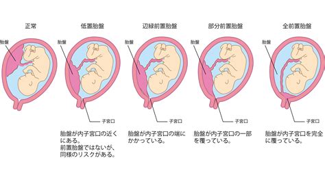 胎盤低位